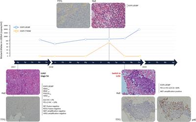 <mark class="highlighted">Multiple Resistance</mark> Mechanisms to Tyrosine Kinase Inhibitors in EGFR Mutated Lung Adenocarcinoma: A Case Report Harboring EGFR Mutations, MET Amplification, and Squamous Cell Transformation